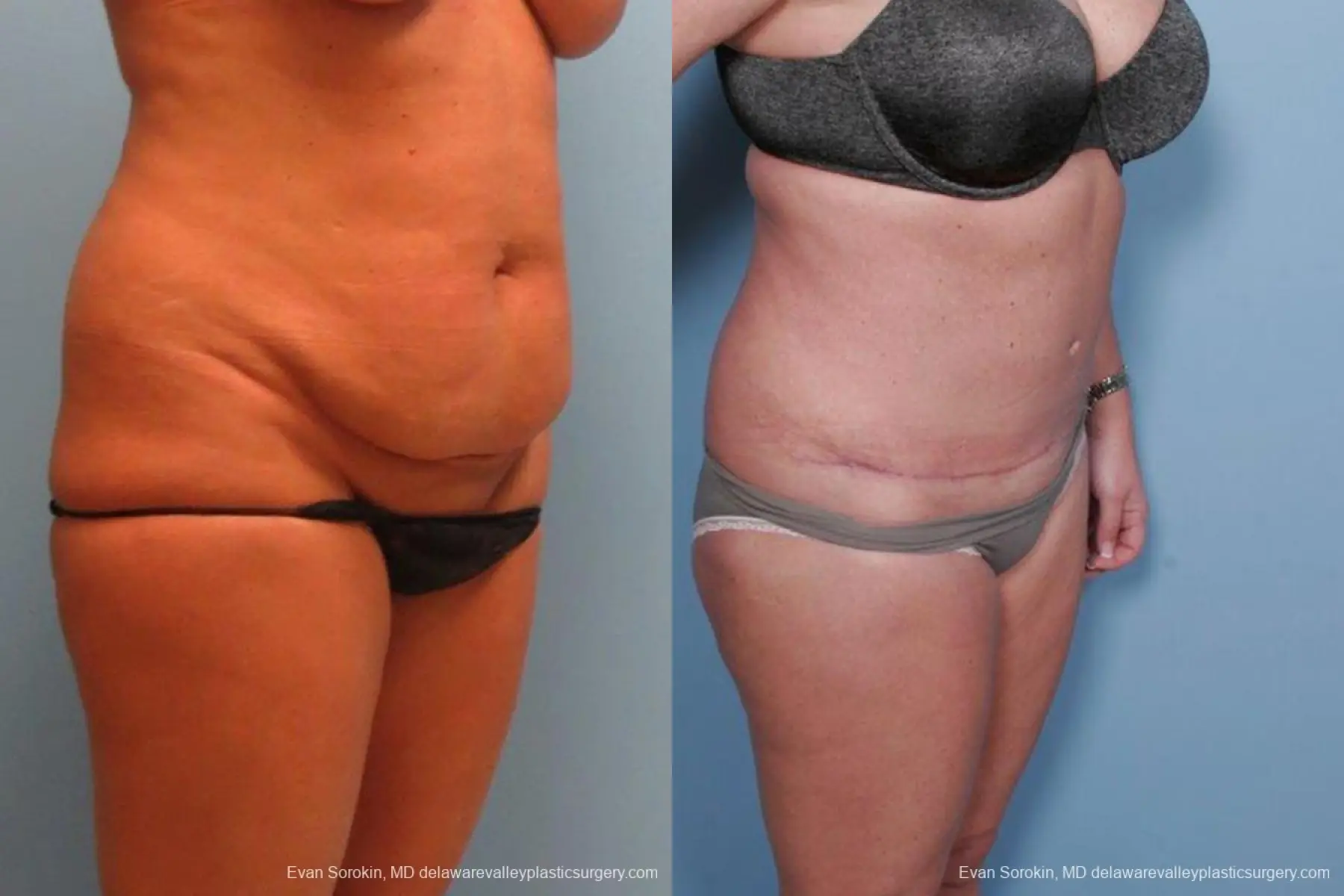 Philadelphia Abdominoplasty 9463 - Before and After 2