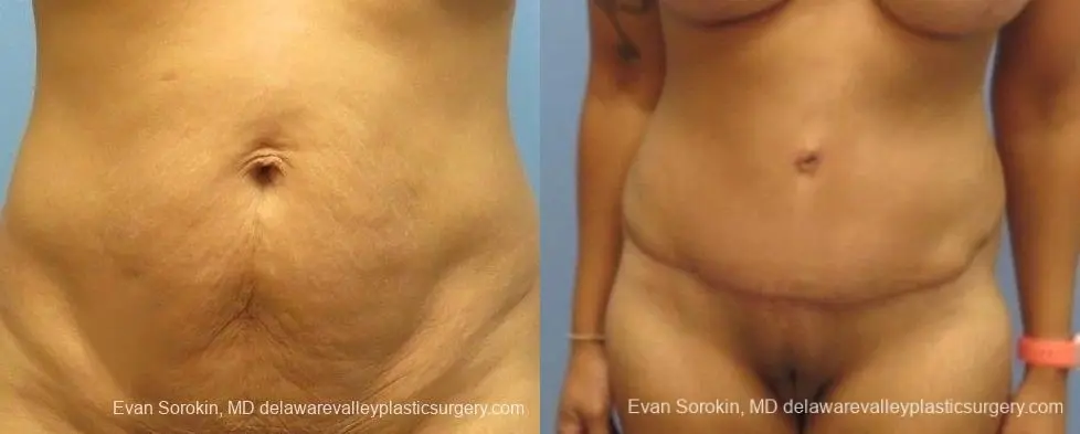 Philadelphia Abdominoplasty 8825 - Before and After