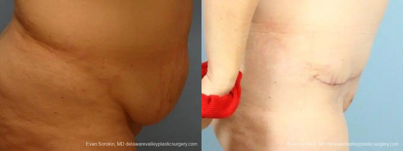Philadelphia Abdominoplasty 9467 - Before and After 3