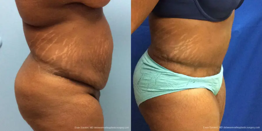 Philadelphia Abdominoplasty 10817 - Before and After 3