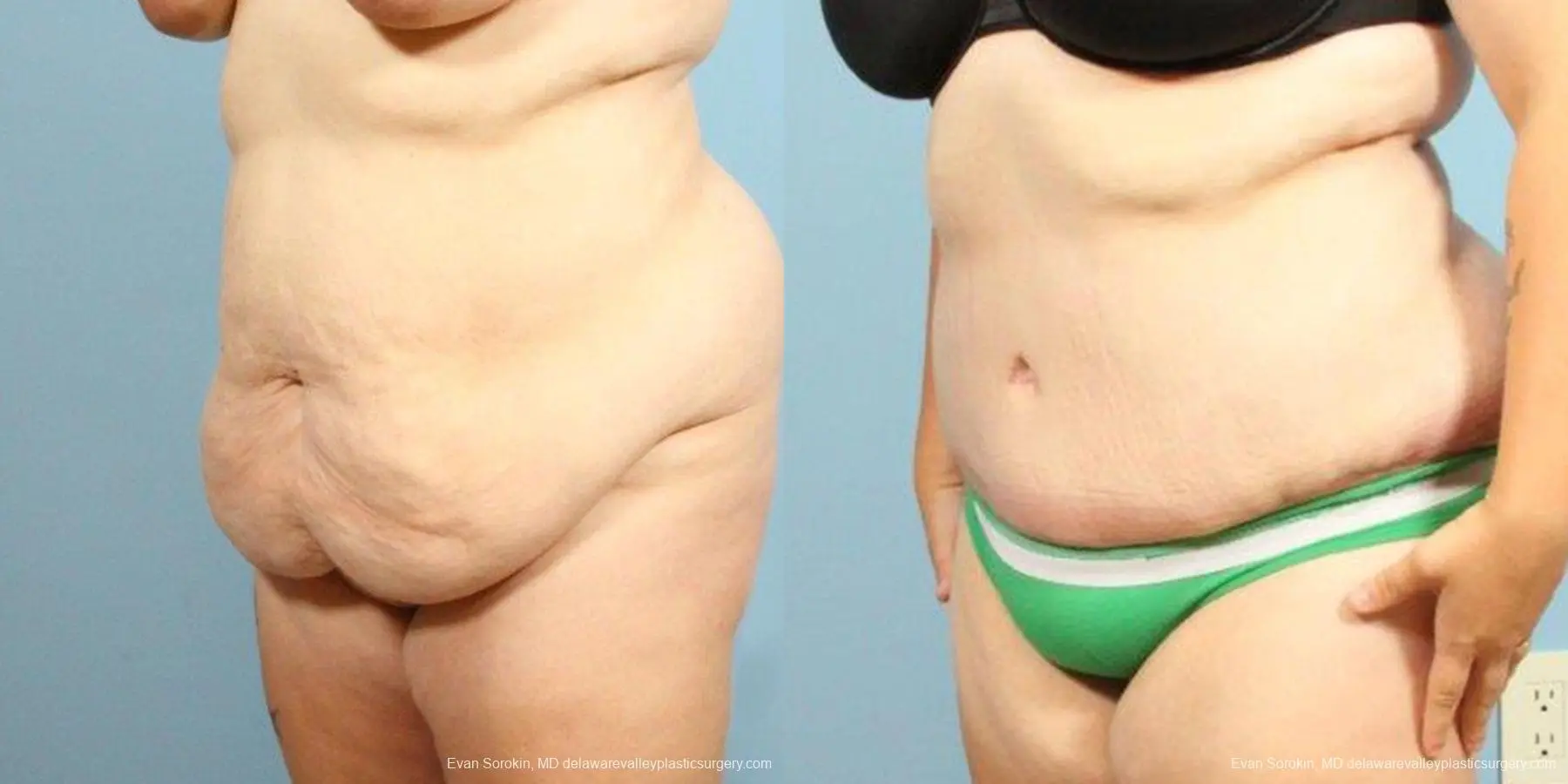 Philadelphia Abdominoplasty 9466 - Before and After 3