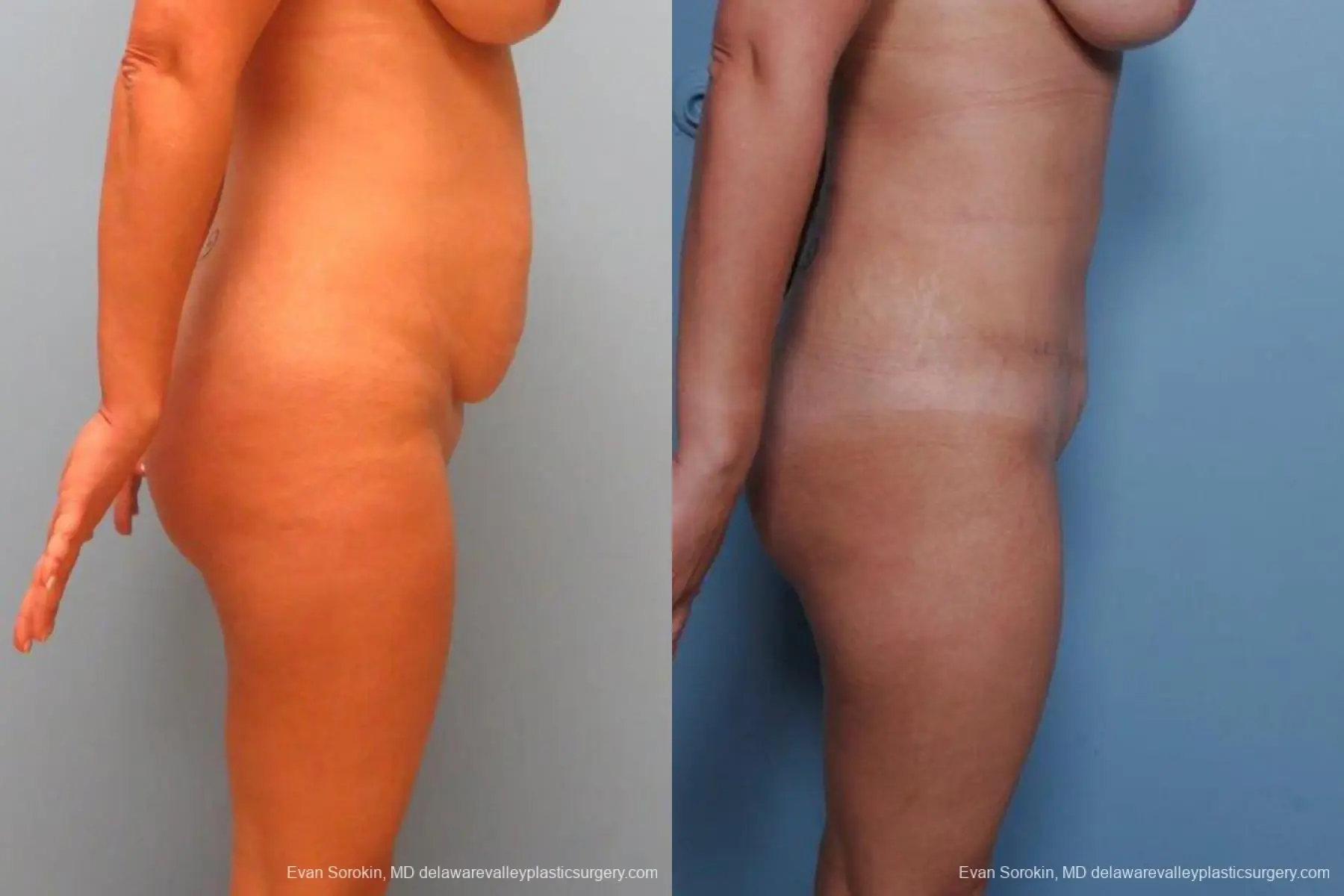 Philadelphia Abdominoplasty 9460 - Before and After 3