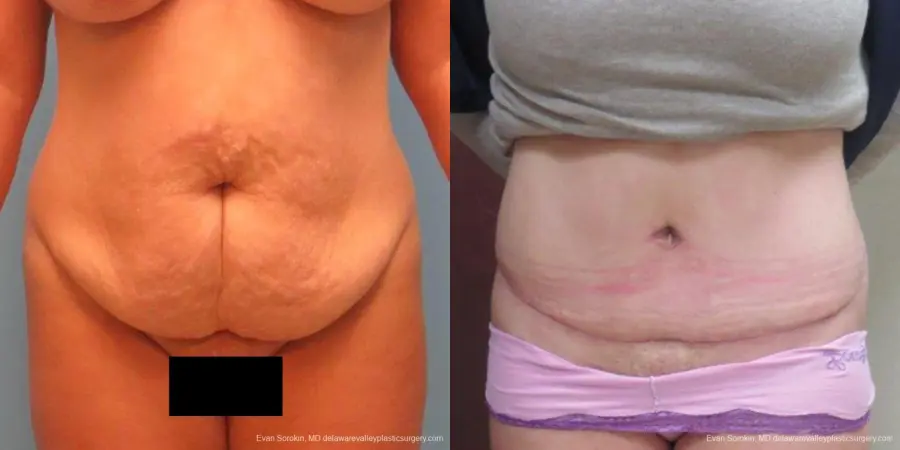 Philadelphia Abdominoplasty 9267 - Before and After 1