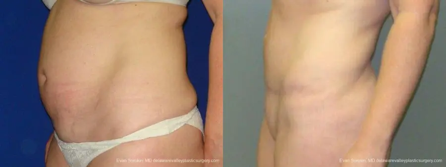 Philadelphia Abdominoplasty 9474 - Before and After 5