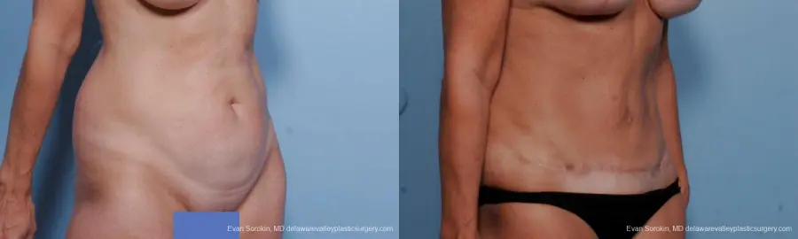 Philadelphia Abdominoplasty 9376 - Before and After 2