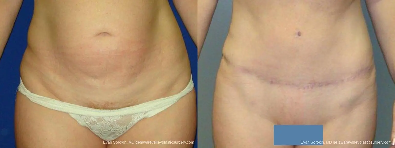 Philadelphia Abdominoplasty 9474 - Before and After 1
