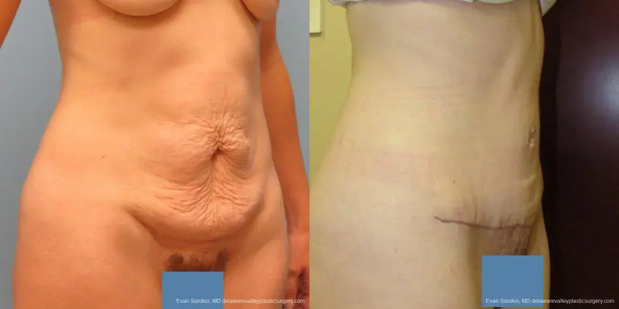 Philadelphia Abdominoplasty 9465 - Before and After 2