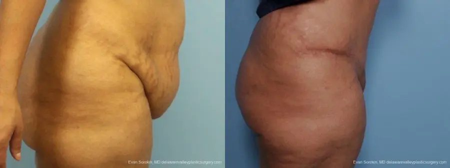 Philadelphia Abdominoplasty 9462 - Before and After 3