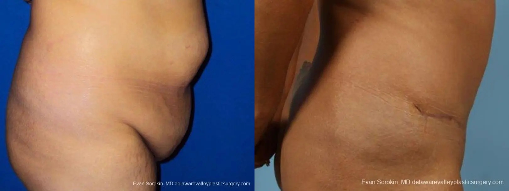 Philadelphia Abdominoplasty 9471 - Before and After 3