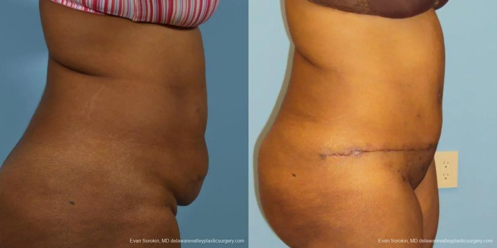 Philadelphia Abdominoplasty 9472 - Before and After 3