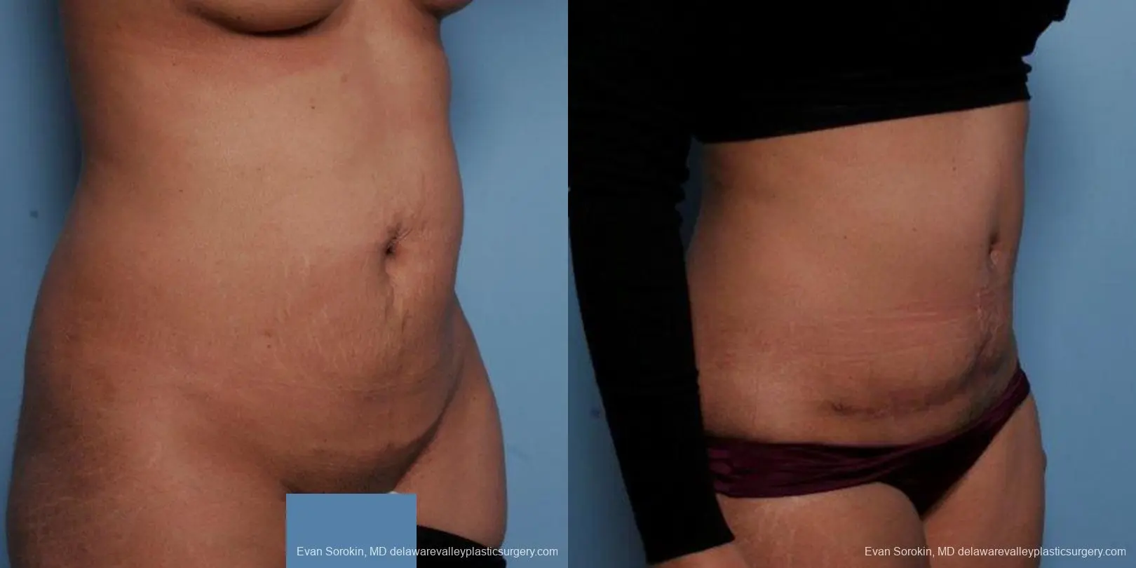Philadelphia Abdominoplasty 9479 - Before and After 2