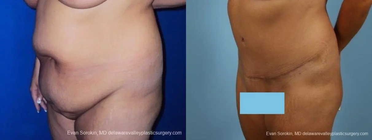 Philadelphia Abdominoplasty 8700 - Before and After 3