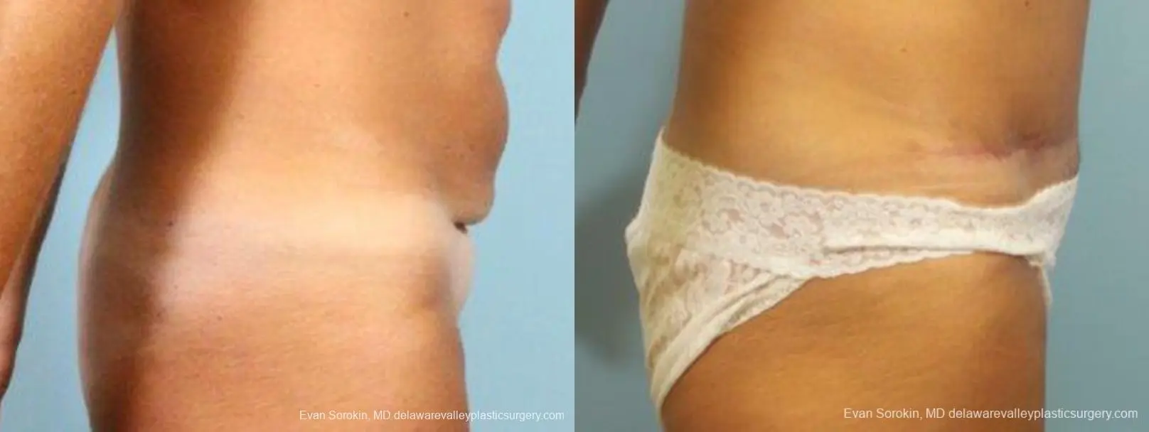 Philadelphia Abdominoplasty 9464 - Before and After 3