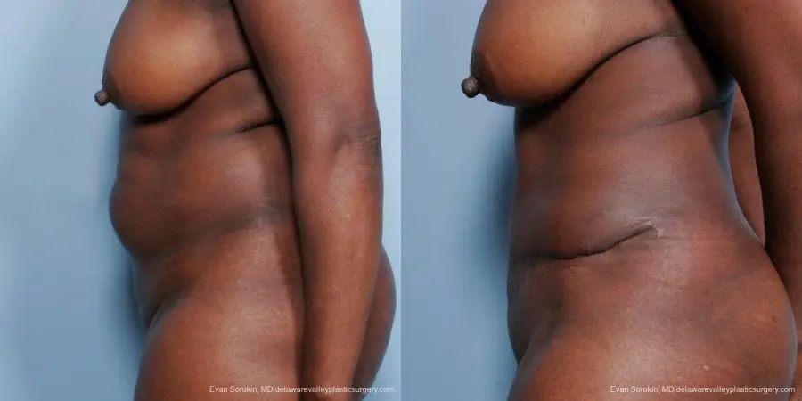 Philadelphia Abdominoplasty 9477 - Before and After 5