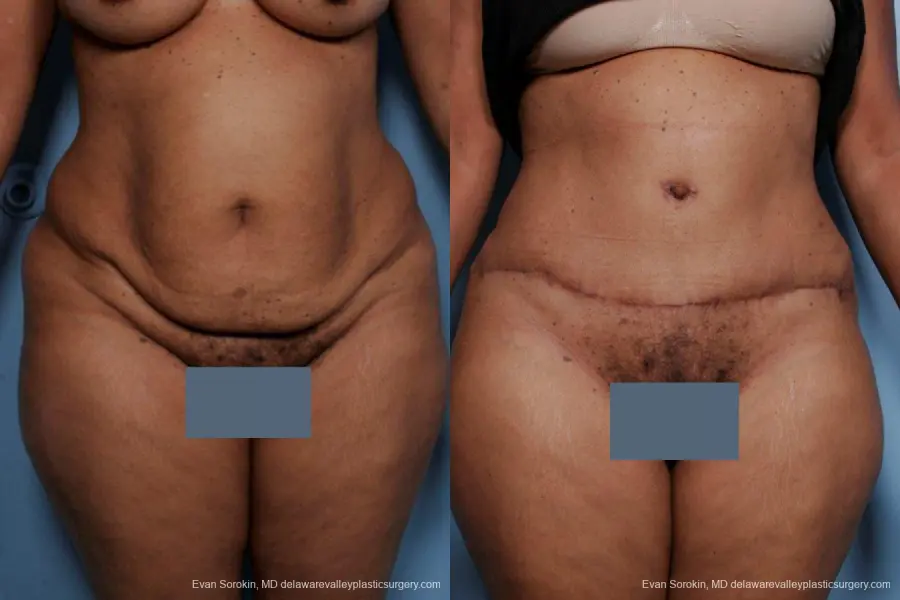 Philadelphia Abdominoplasty 9461 - Before and After 1