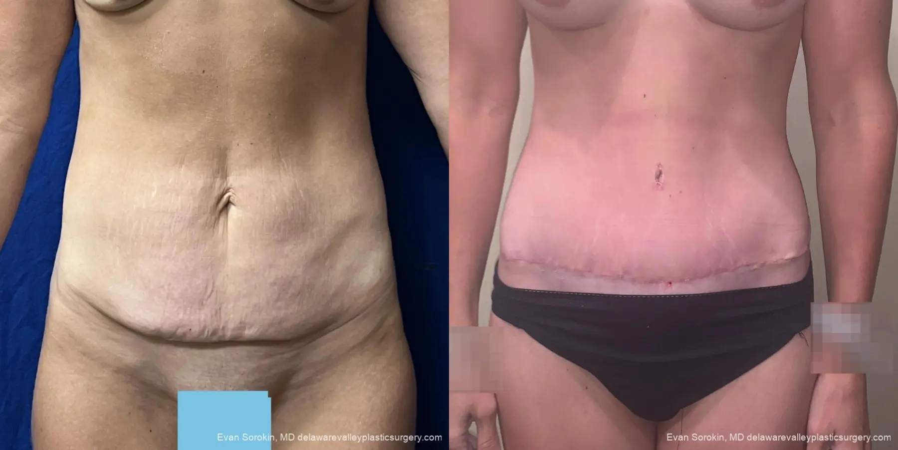 Abdominoplasty: Patient 3 - Before and After 1