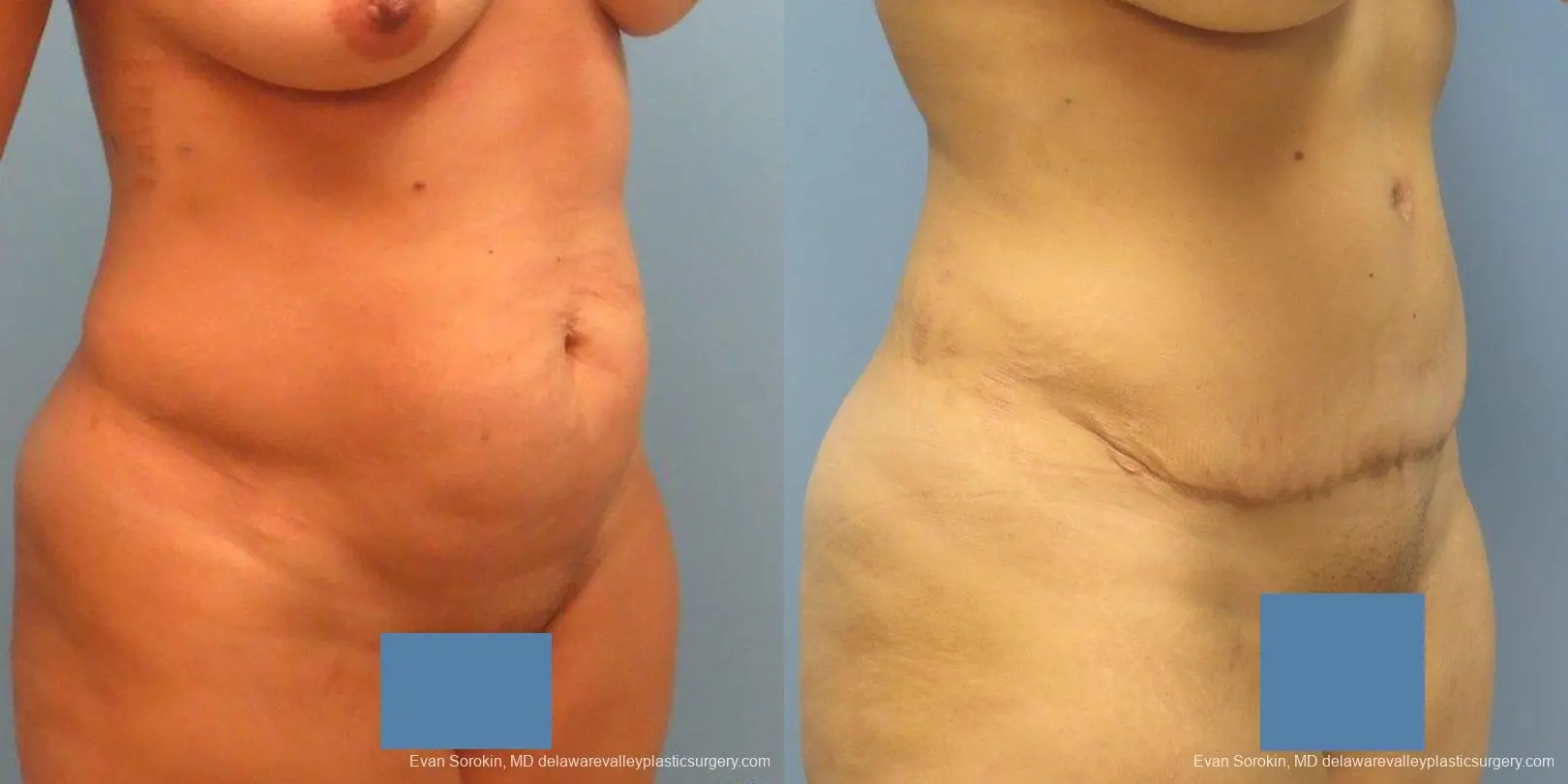 Philadelphia Abdominoplasty 9478 - Before and After 4