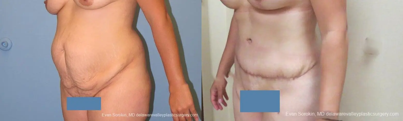 Philadelphia Abdominoplasty 10122 - Before and After 4