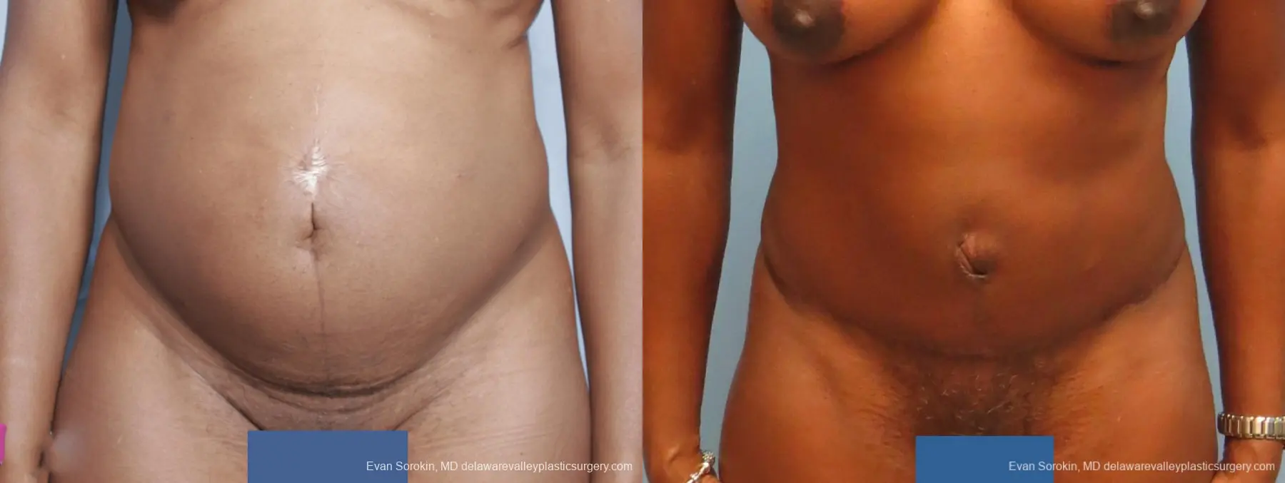 Philadelphia Abdominoplasty 9339 - Before and After