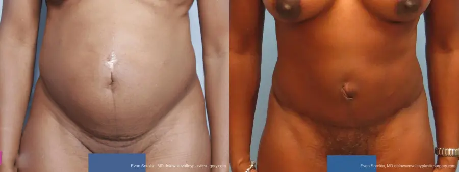 Philadelphia Abdominoplasty 9339 - Before and After 1