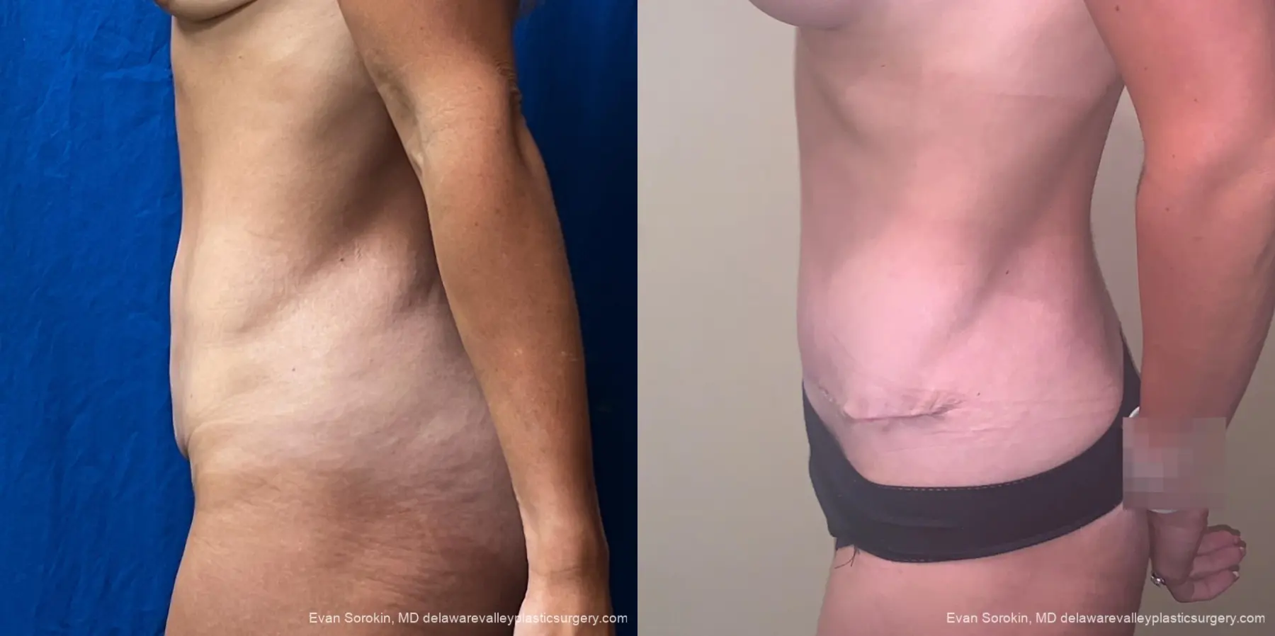 Abdominoplasty: Patient 3 - Before and After 5