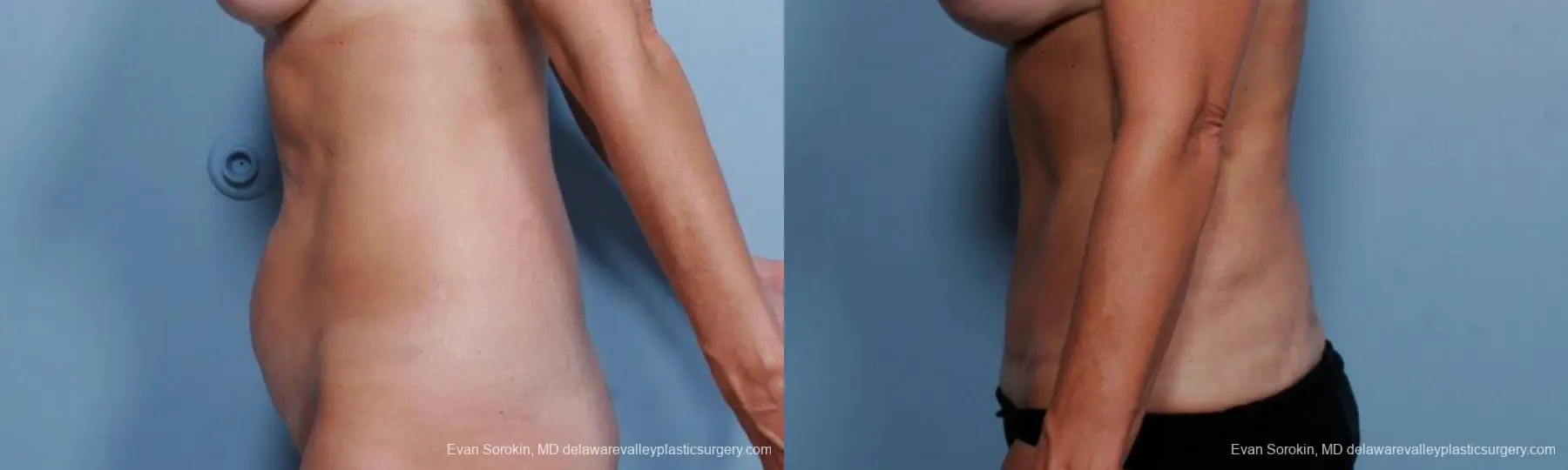 Philadelphia Abdominoplasty 9376 - Before and After 5