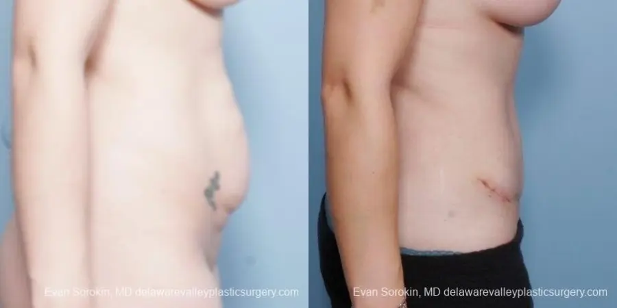 Philadelphia Abdominoplasty 8681 - Before and After 4