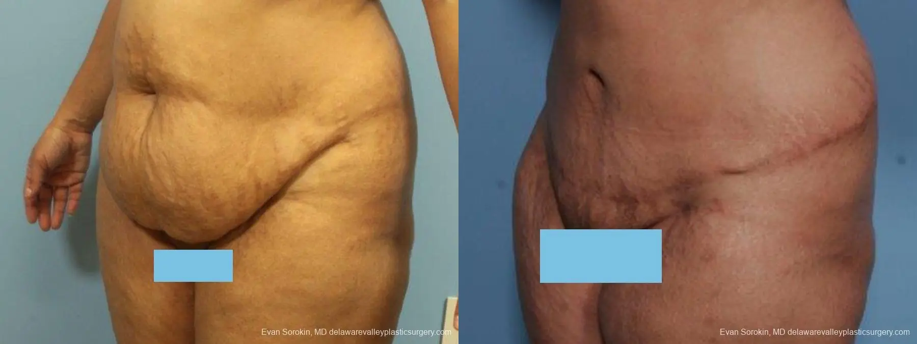 Philadelphia Abdominoplasty 9462 - Before and After 4