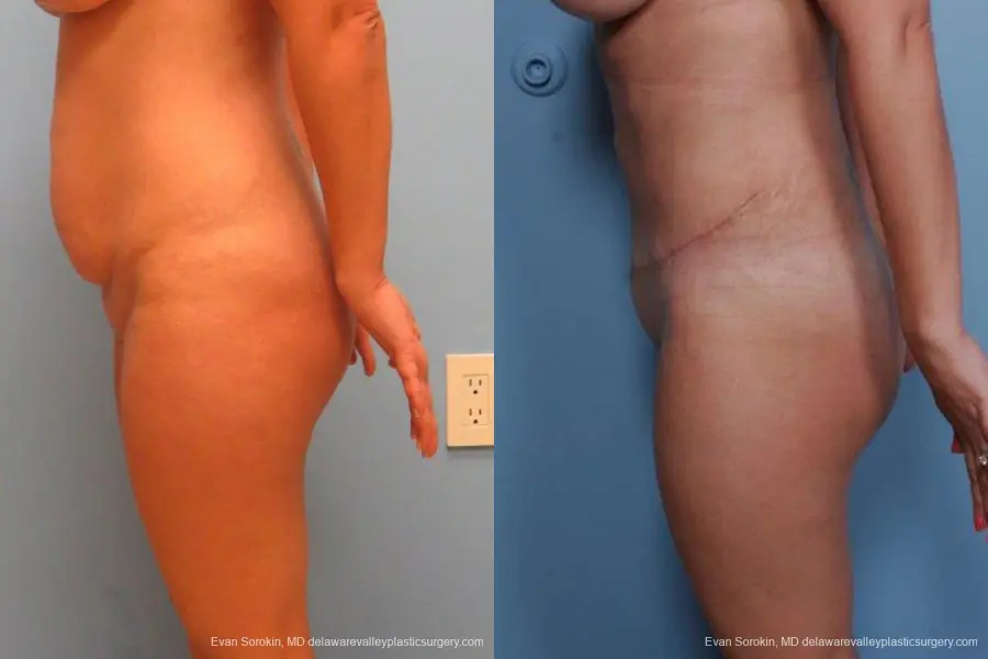 Philadelphia Abdominoplasty 9460 - Before and After 5