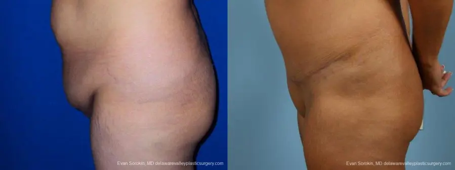 Philadelphia Abdominoplasty 9471 - Before and After 5