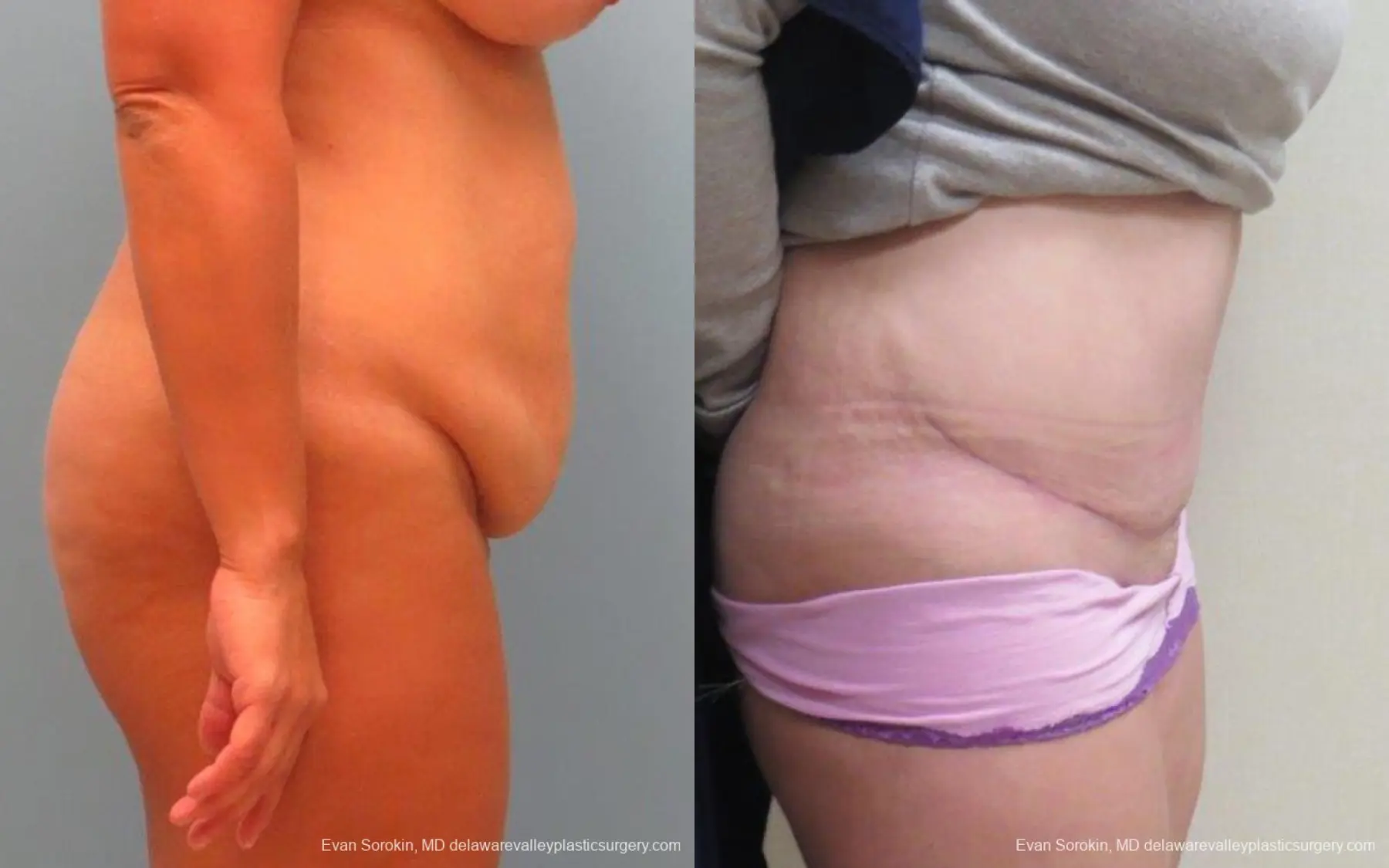 Philadelphia Abdominoplasty 9267 - Before and After 3