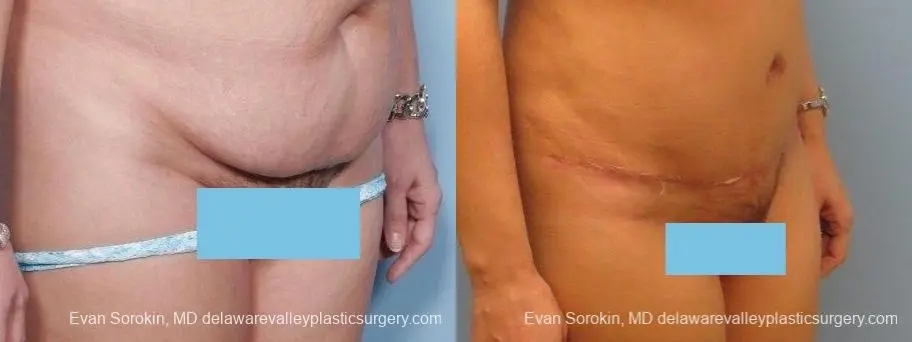 Philadelphia Abdominoplasty 8672 - Before and After 2