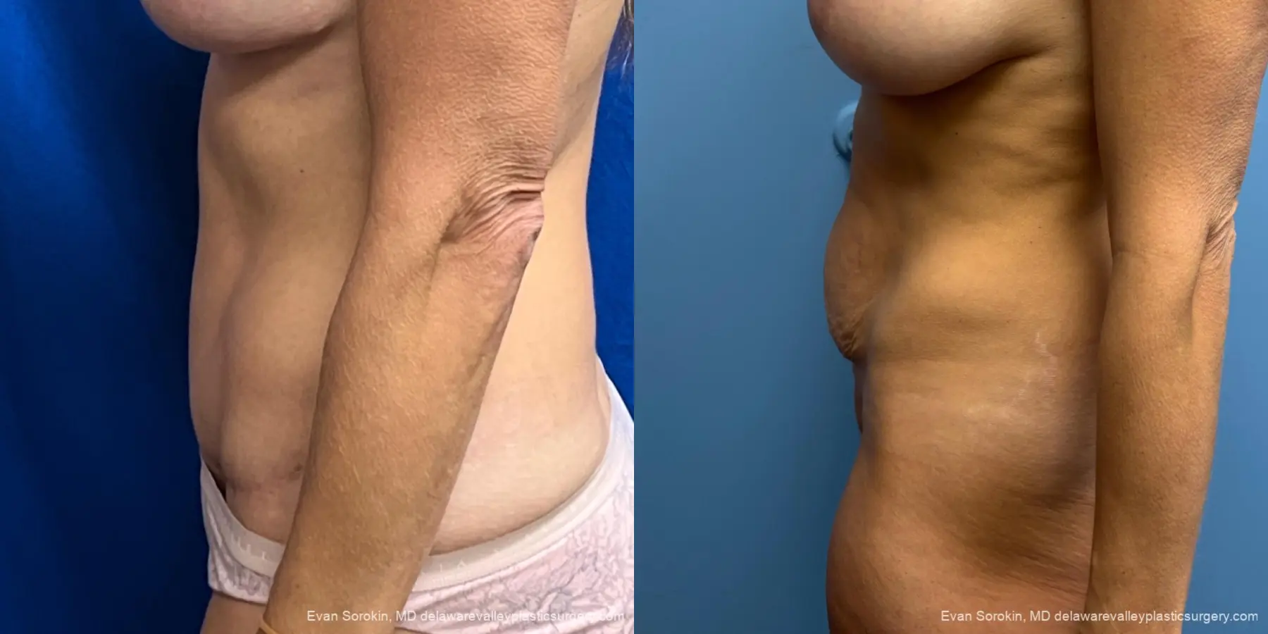 Abdominoplasty: Patient 44 - Before and After 5