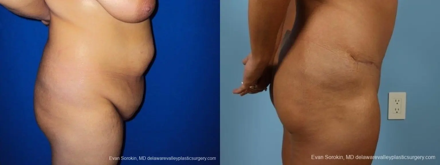 Philadelphia Abdominoplasty 8700 - Before and After 4