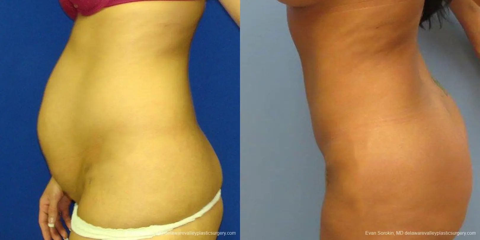 Philadelphia Abdominoplasty 9475 - Before and After 5