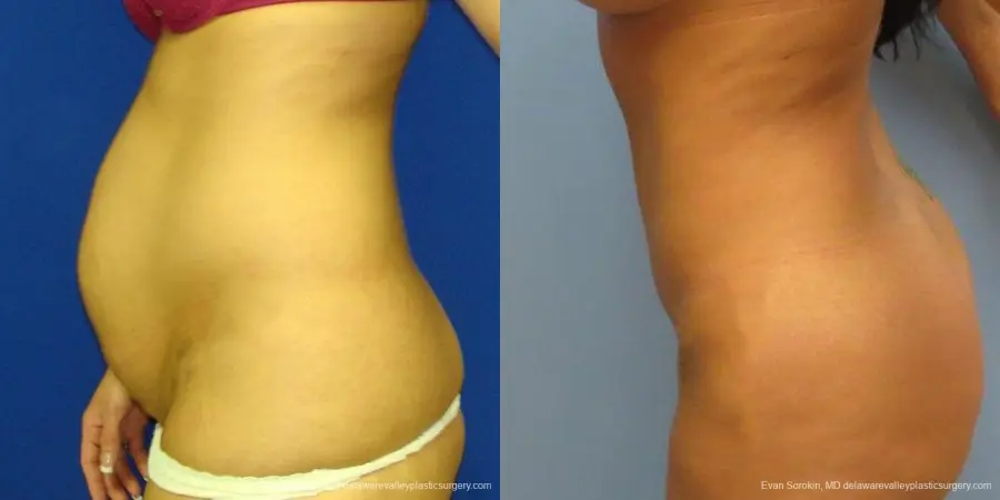 Philadelphia Abdominoplasty 9475 - Before and After 5