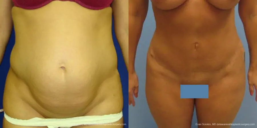 Philadelphia Abdominoplasty 9475 - Before and After