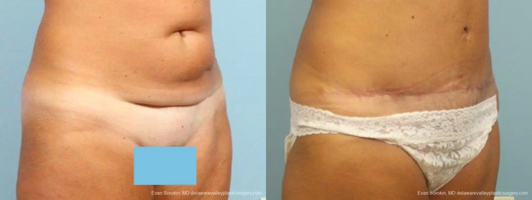 Philadelphia Abdominoplasty 9464 - Before and After 2