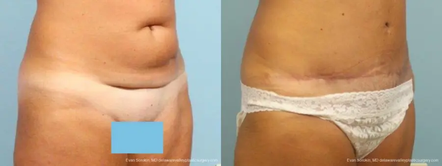 Philadelphia Abdominoplasty 9464 - Before and After 2
