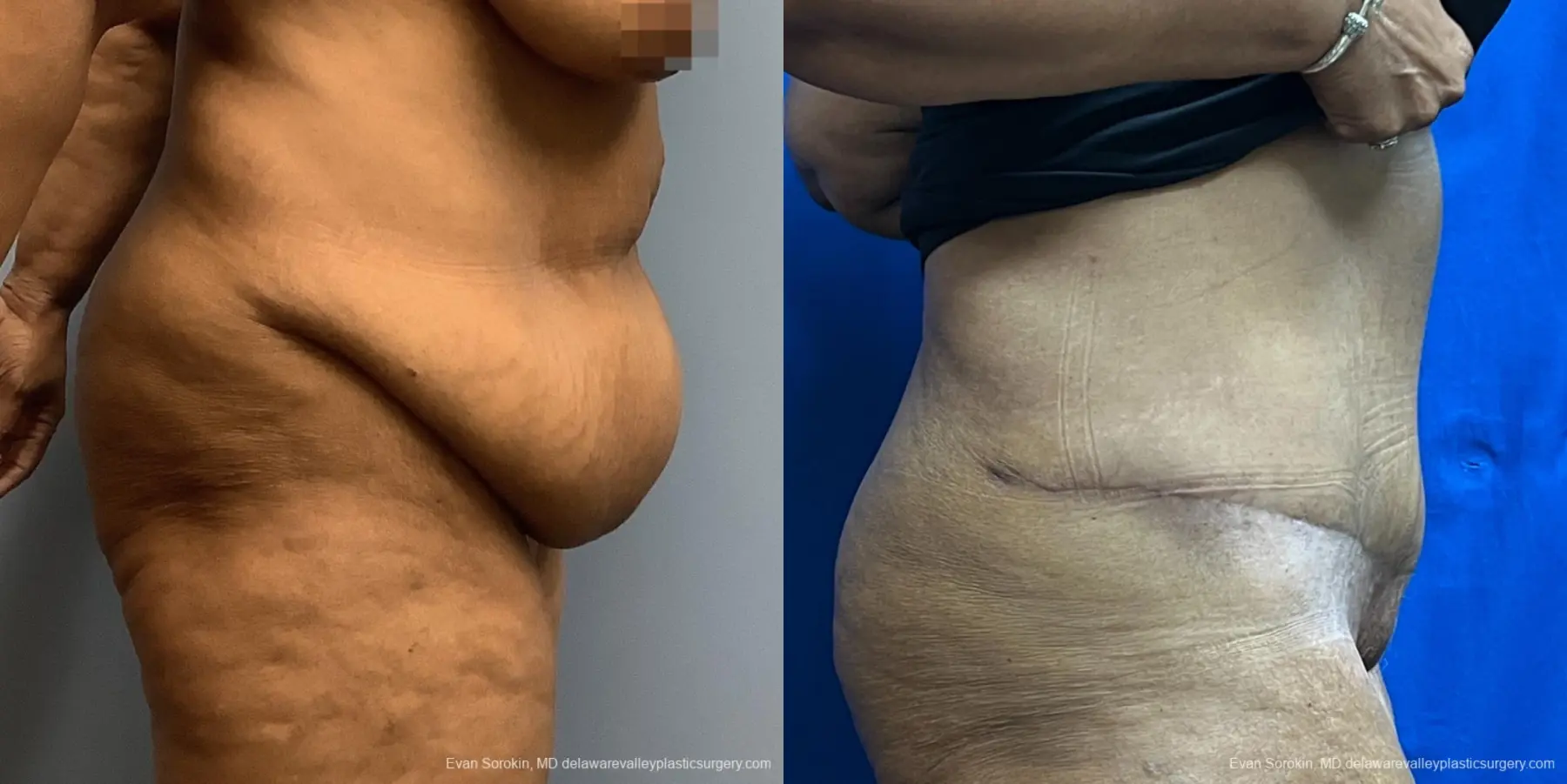 Abdominoplasty: Patient 38 - Before and After 3