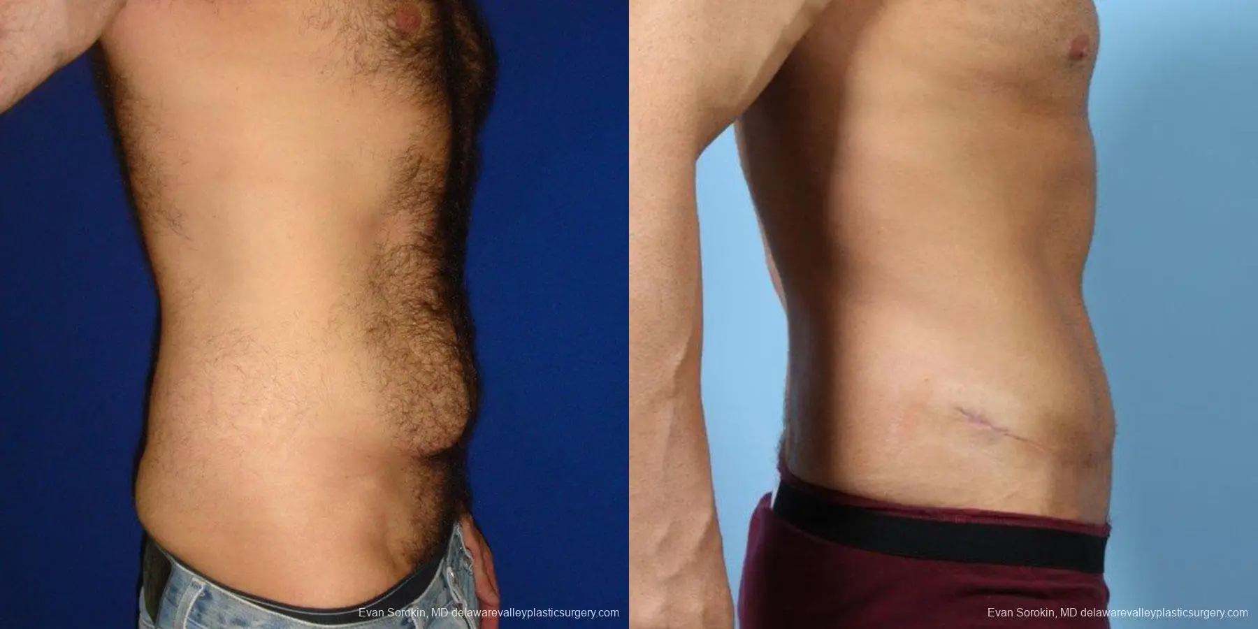 Philadelphia Abdominoplasty 9468 - Before and After 3