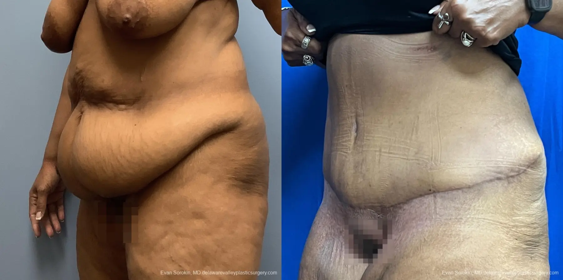 Abdominoplasty: Patient 38 - Before and After 4