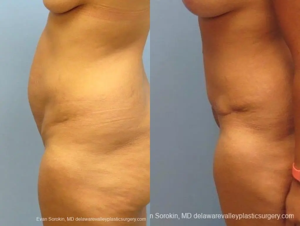 Philadelphia Abdominoplasty 8825 - Before and After 3