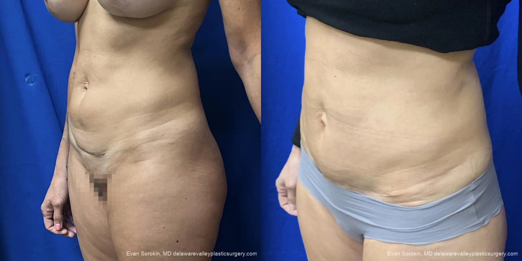 Abdominoplasty: Patient 46 - Before and After 4