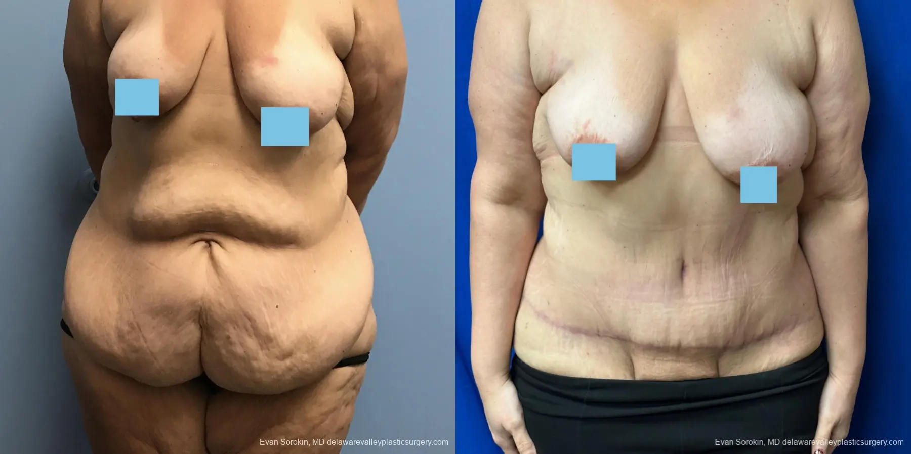 Abdominoplasty: Patient 37 - Before and After 1