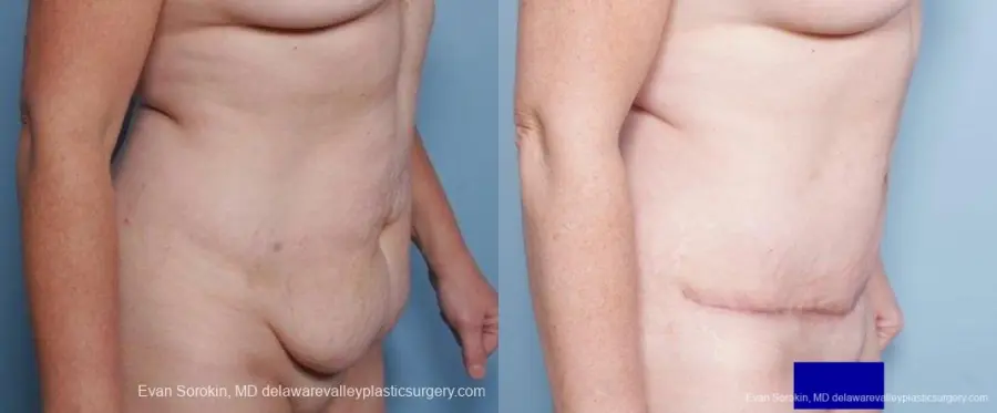 Philadelphia Abdominoplasty 9315 - Before and After 4