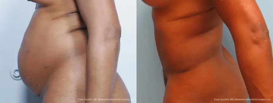 Philadelphia Abdominoplasty 9339 - Before and After 5