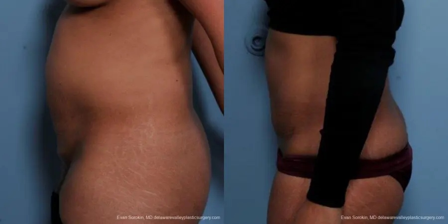 Philadelphia Abdominoplasty 9479 - Before and After 5
