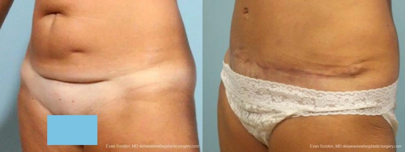 Philadelphia Abdominoplasty 9464 - Before and After 4