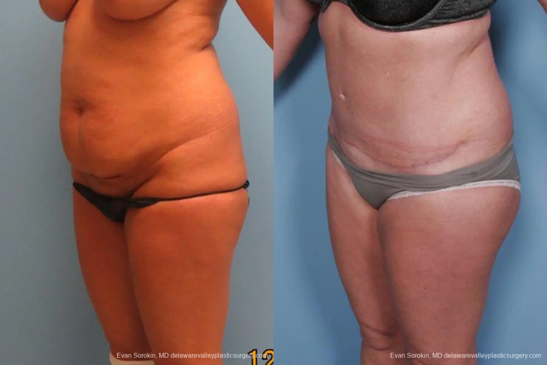 Philadelphia Abdominoplasty 9463 - Before and After 4